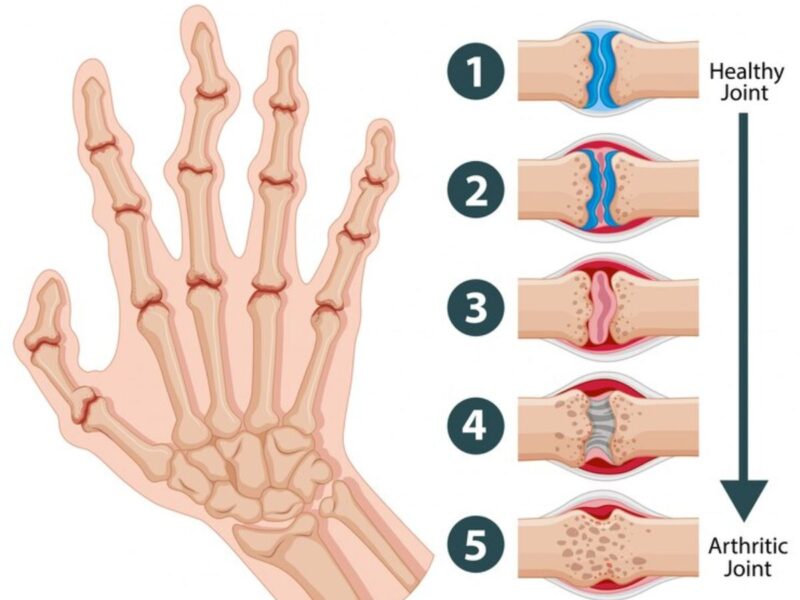 What is The Difference Between Osteoarthritis and Rheumatoid Arthritis?