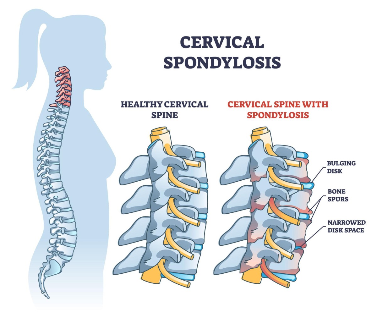 Physiotherapy neck treatment cervical spondylitis Kolkata